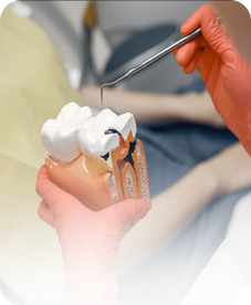 Dental Fillings