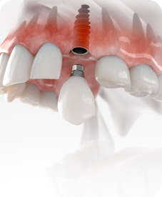 Dental Implants