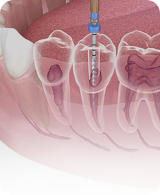 Root Canal Treatment