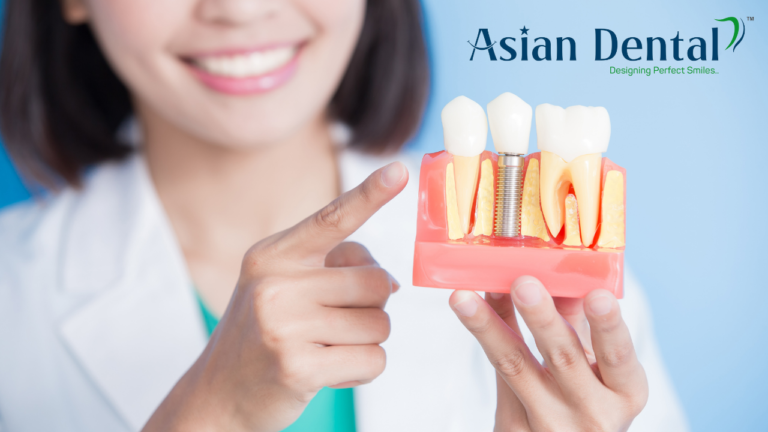 Dental Implants in Vijayawada