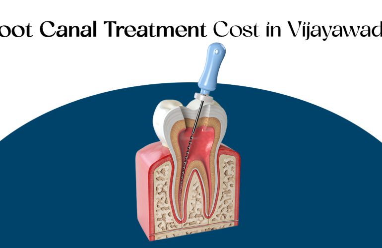 root canal treatment cost in vijayawada
