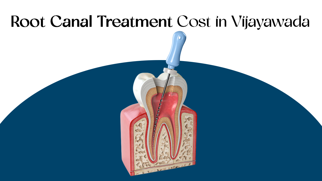 root canal treatment cost in vijayawada