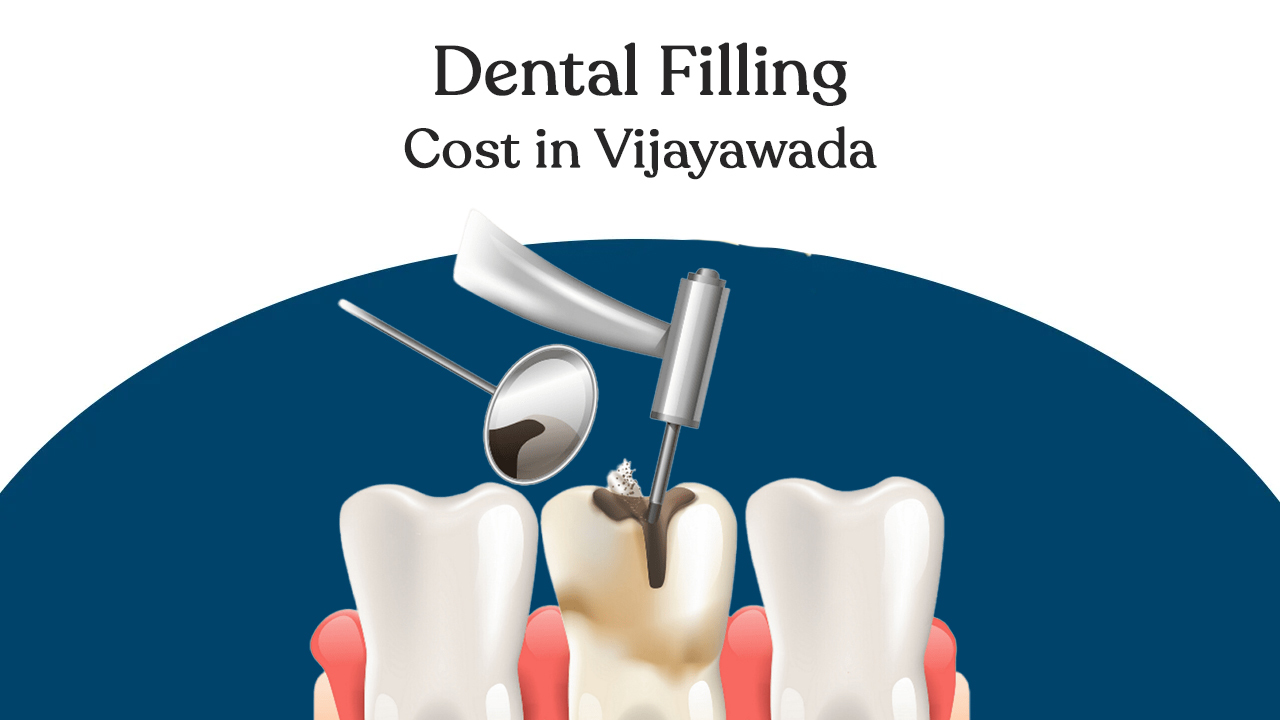 dental filling cost in vijayawada
