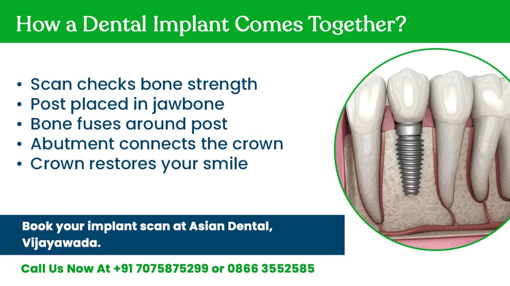 how dental implant comes together
